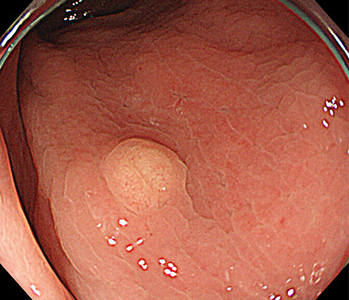 直腸カルチノイド腫瘍