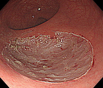 直腸カルチノイド腫瘍