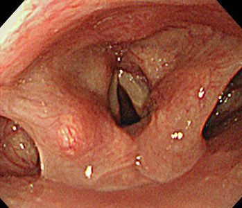 喉頭（経鼻）