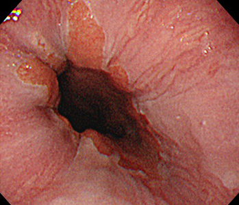 食道・胃境界(経鼻)