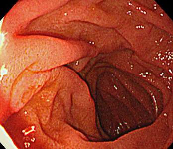 十二指腸(経鼻)