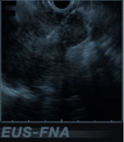 超音波内視鏡下穿刺術(EUS-FNA)